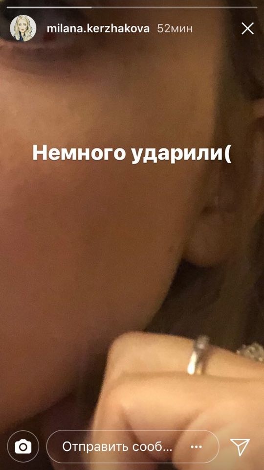 Милана поделилась ужасающим кадром Фото: «Инстаграм»