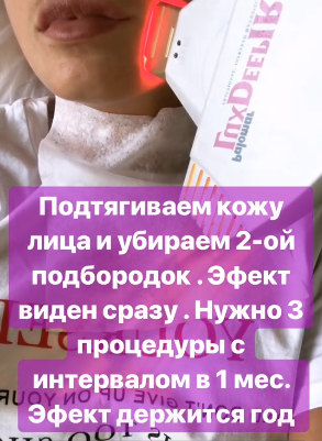 Затем прошлись специальным аппаратом по контуру лица Фото: «Инстаграм»