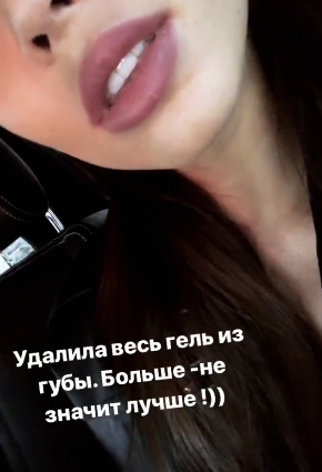 Настя Костенко уменьшила губы Фото: 