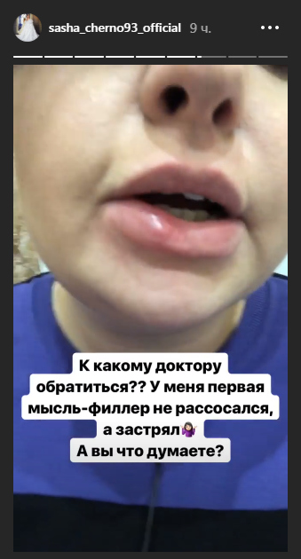 Саша Черно ужаснула снимком распухшей губы Фото: «Инстаграм»