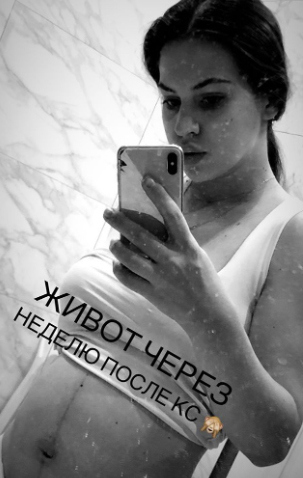 Артёмова не стесняется показывать, как выглядит после операции Фото: «Инстаграм»