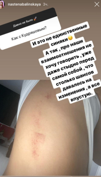 Балинская ходит с синяками Фото: «Инстаграм»