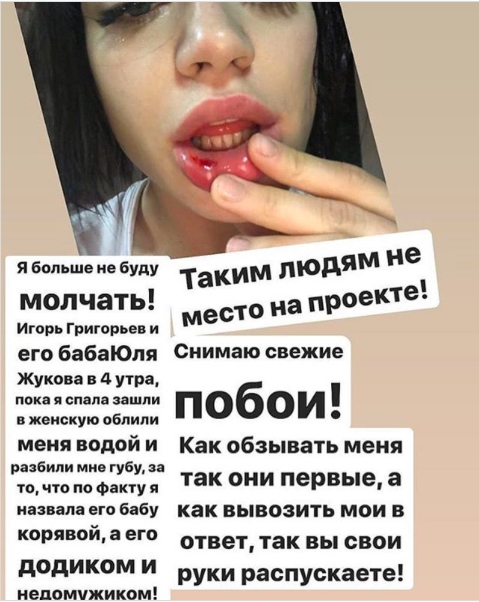 Селена показала лицо после избиения Фото: «Инстаграм»